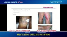 Malattia venosa cronica degli arti inferiori