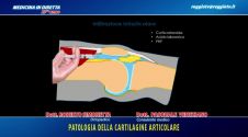 Patologia della cartilagine articolare